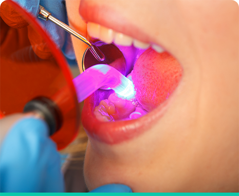 Patient receiving cosmetic bonding in Houston