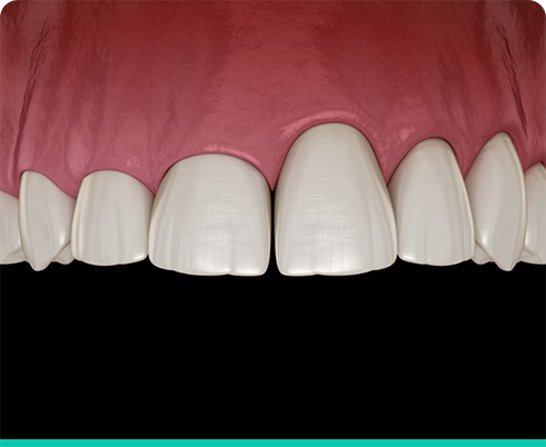 Illustration of smile with differently sized teeth