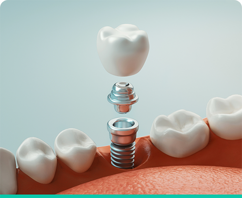 Dental implant abutment and crown being placed in lower arch