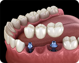 Two dental implants and a dental bridge