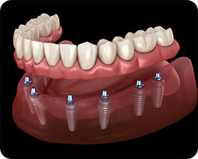 Full denture being attached to multiple dental implants