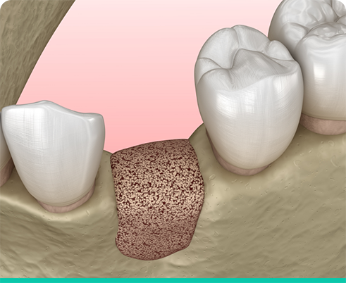 Illustration of bone grafting in the lower jaw