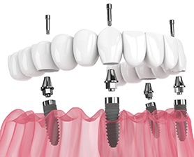 Digital image of an implant denture