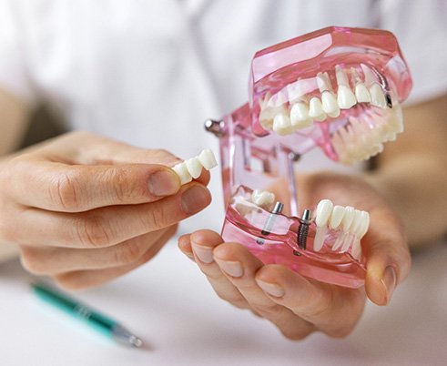 A dentist handling a dental implant bridge model