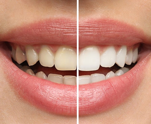 Closeup of patient's teeth before and after teeth whitening