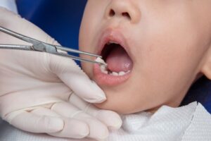 Child having tooth extracted.