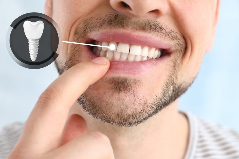 A closeup of a man pointing out his dental implant